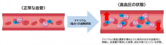 食塩過剰摂取による高血圧のメカニズム