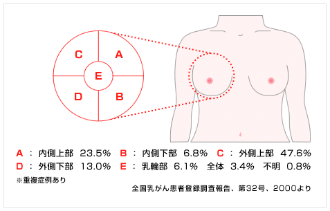 乳がん発生部位